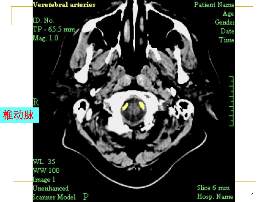 头颅CT读片教学课件.ppt_第3页