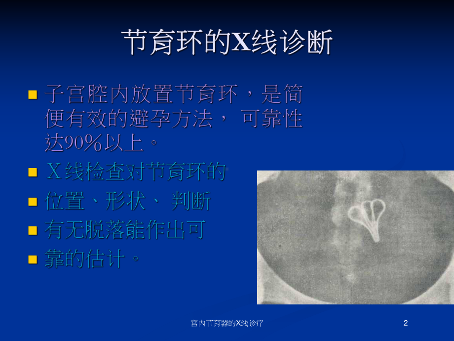 宫内节育器的X线诊疗培训课件.ppt_第2页