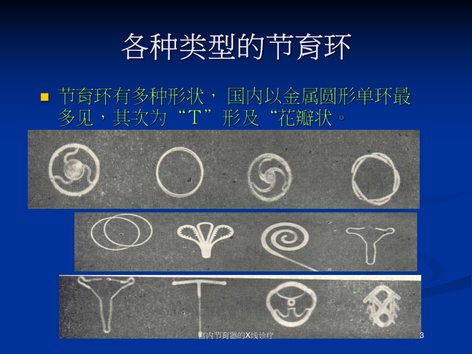 宫内节育器的X线诊疗培训课件.ppt_第3页