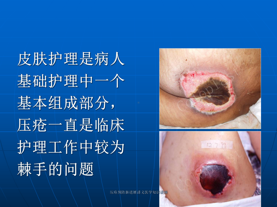 压疮预防新进展讲义医学知识讲座培训课件.ppt_第2页