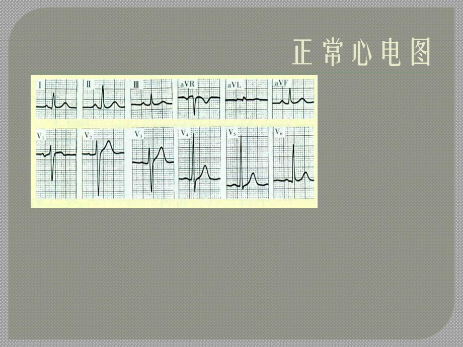 内科学诊断学重点心电图快速识图课件.ppt_第1页