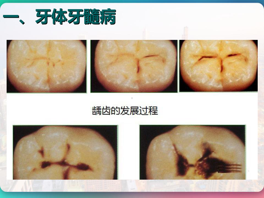 五官科学-口腔科常见疾病-课件.pptx_第3页