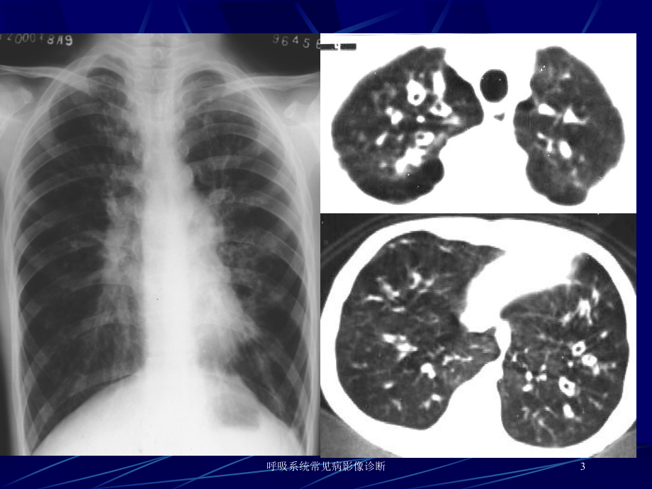 呼吸系统常见病影像诊断培训课件.ppt_第3页