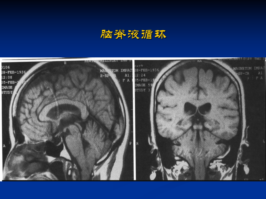 化脑病脑课件.pptx_第3页