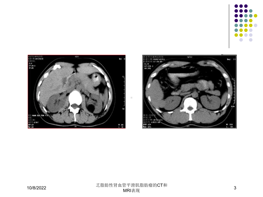 乏脂肪性肾血管平滑肌脂肪瘤的CT和MRI表现课件.ppt_第3页