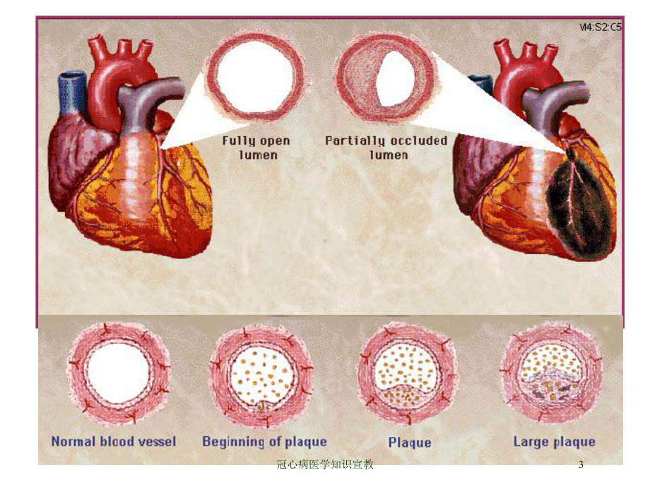 冠心病医学知识宣教培训课件.ppt_第3页