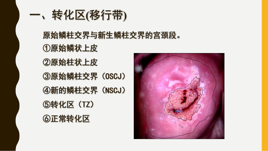 宫颈癌筛查文献汇报HPV和TCT课件.ppt_第1页