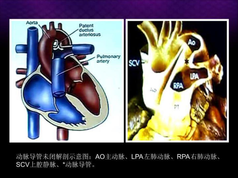 动脉导管未闭超声诊断课件.ppt_第3页