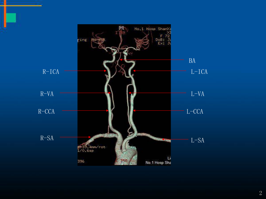 头颈部血管常见变异与病变教学课件.pptx_第2页