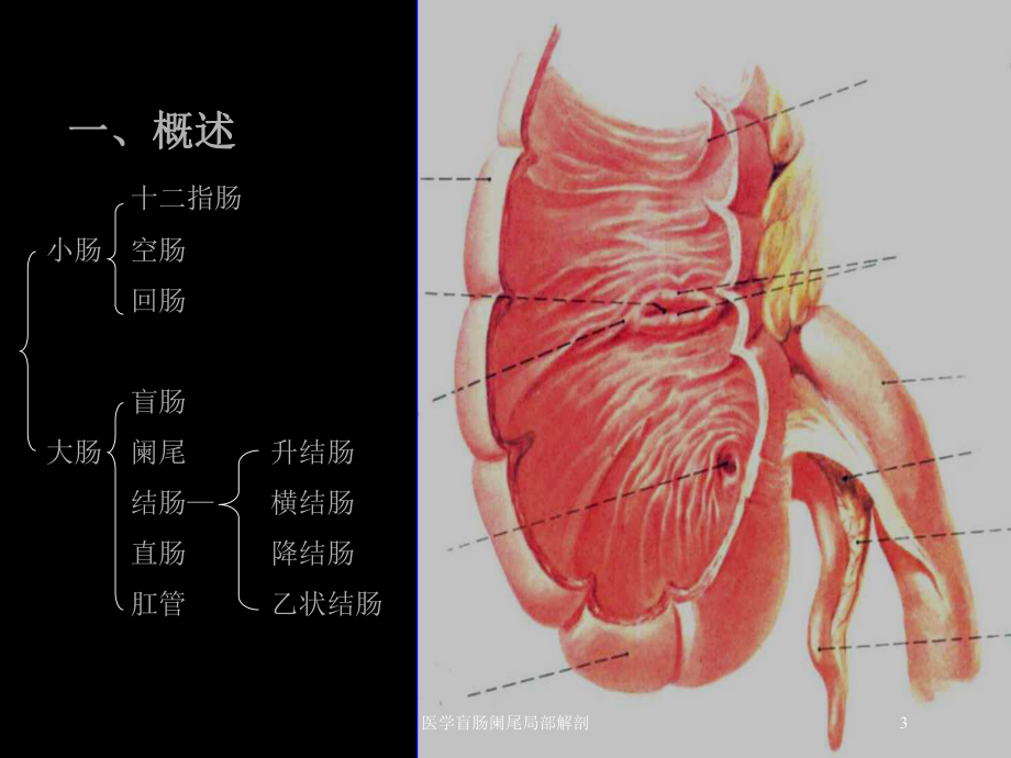 医学盲肠阑尾局部解剖培训课件.ppt_第3页