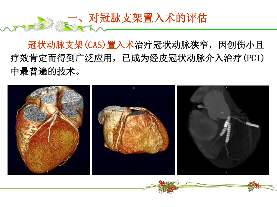 冠状动脉支架及搭桥术的CT评估课件.ppt_第3页