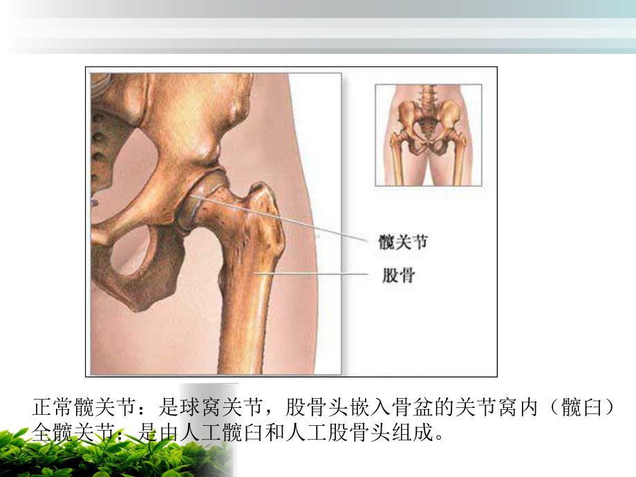 全髋关节置换术后的护理课件演示.ppt_第3页