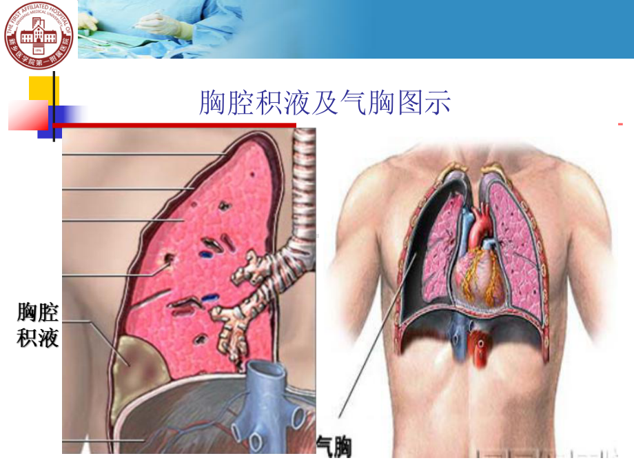 医学课件胸腔穿刺技能操作.ppt_第2页