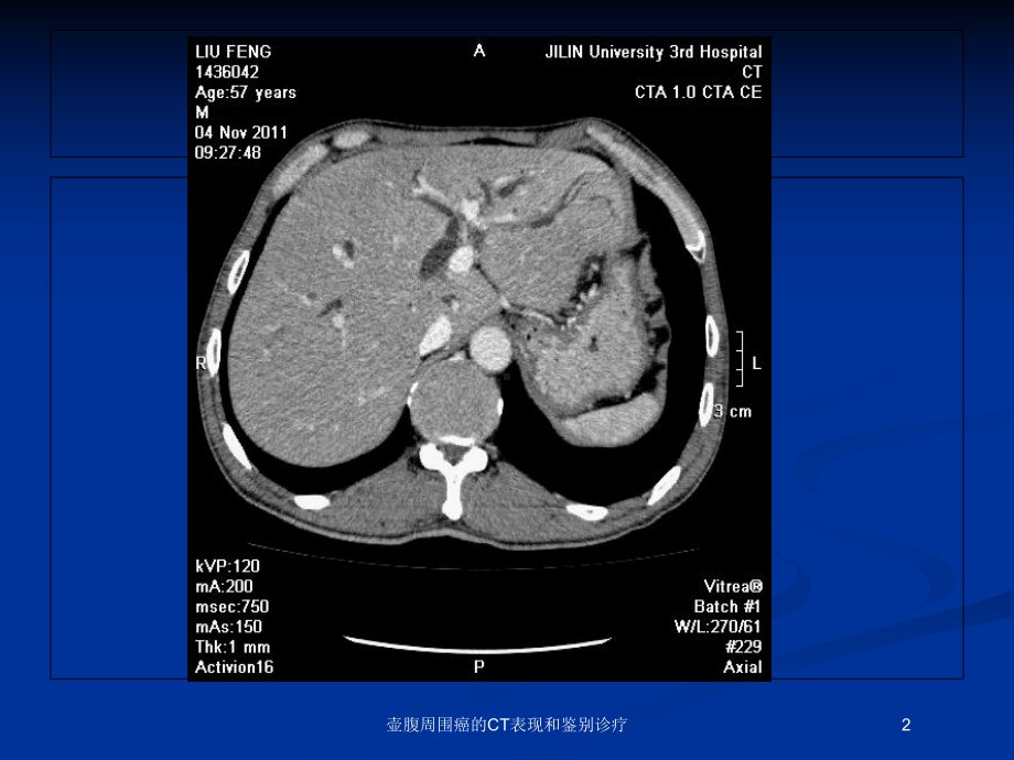 壶腹周围癌的CT表现和鉴别诊疗培训课件.ppt_第2页