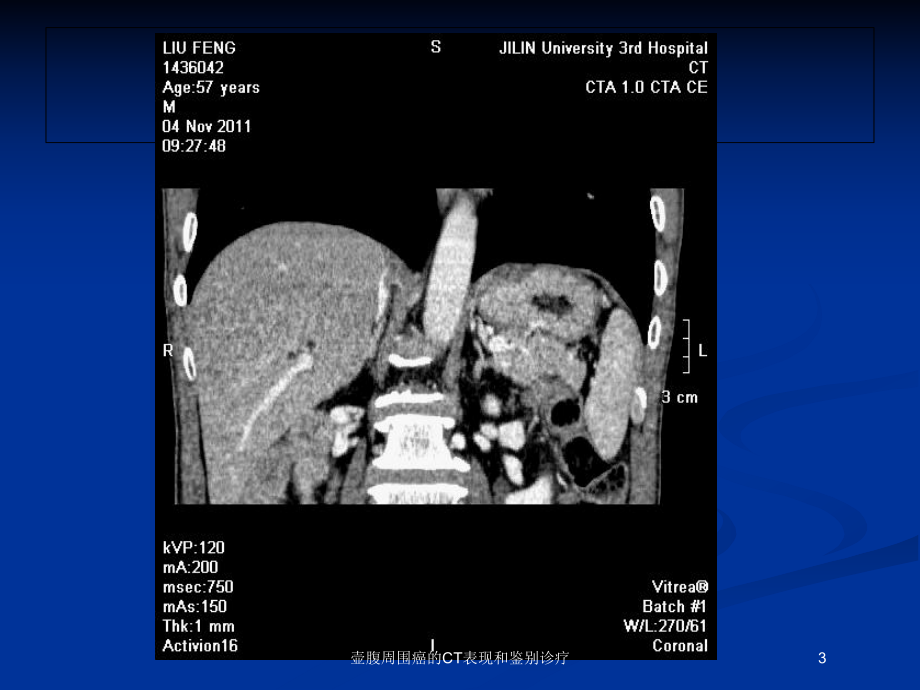 壶腹周围癌的CT表现和鉴别诊疗培训课件.ppt_第3页