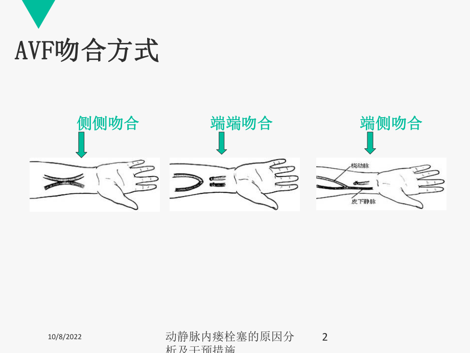 动静脉内瘘栓塞的原因分析及干预措施培训课件.ppt_第2页