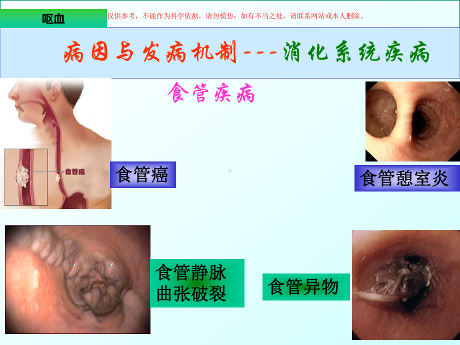 呕血医学知识专题宣讲医学知识专题讲座培训课件.ppt_第3页