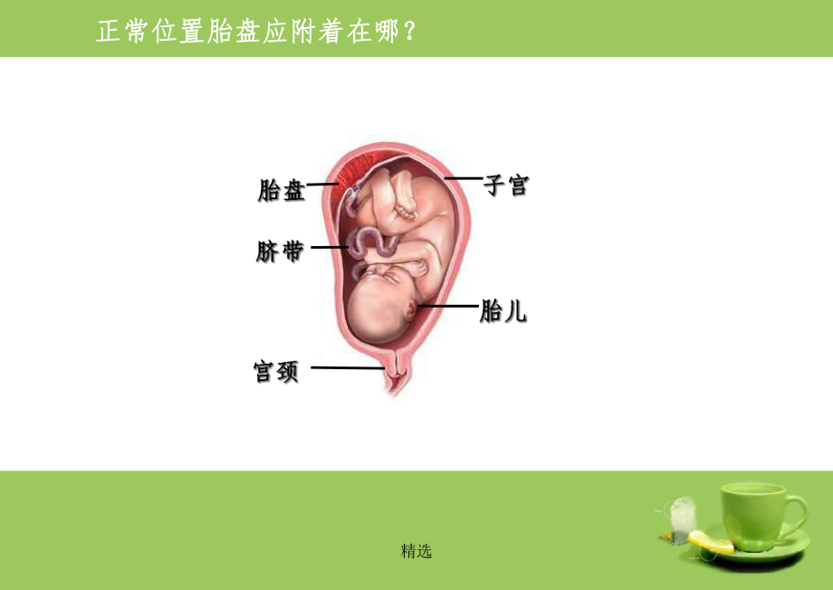 前置胎盘179716课件.ppt_第2页