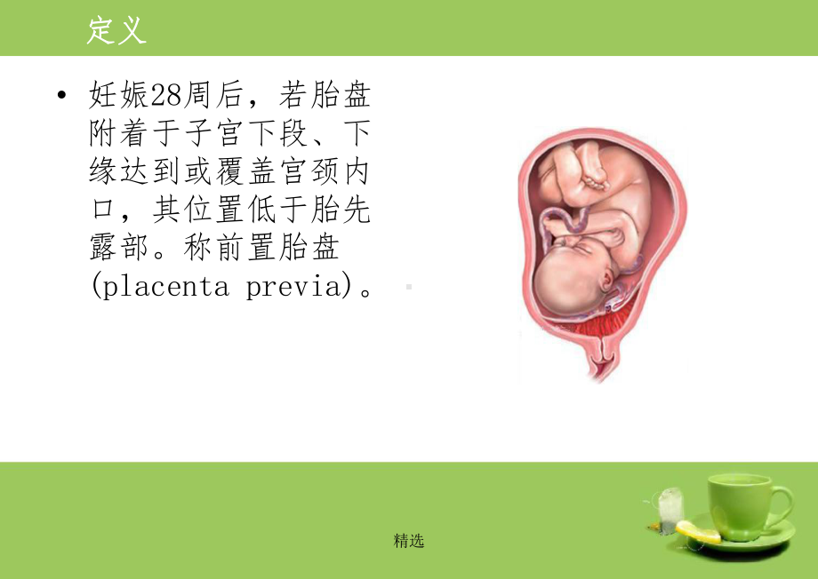 前置胎盘179716课件.ppt_第3页