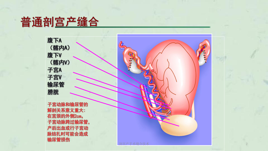 剖宫产手术缝合技术课件.ppt_第2页