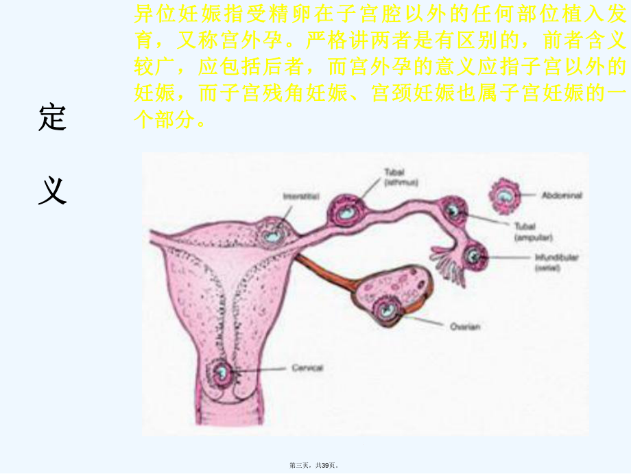 妊娠黄体与宫外孕鉴别诊断课件.ppt_第3页