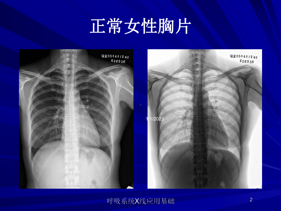 呼吸系统X线应用基础课件.ppt_第2页