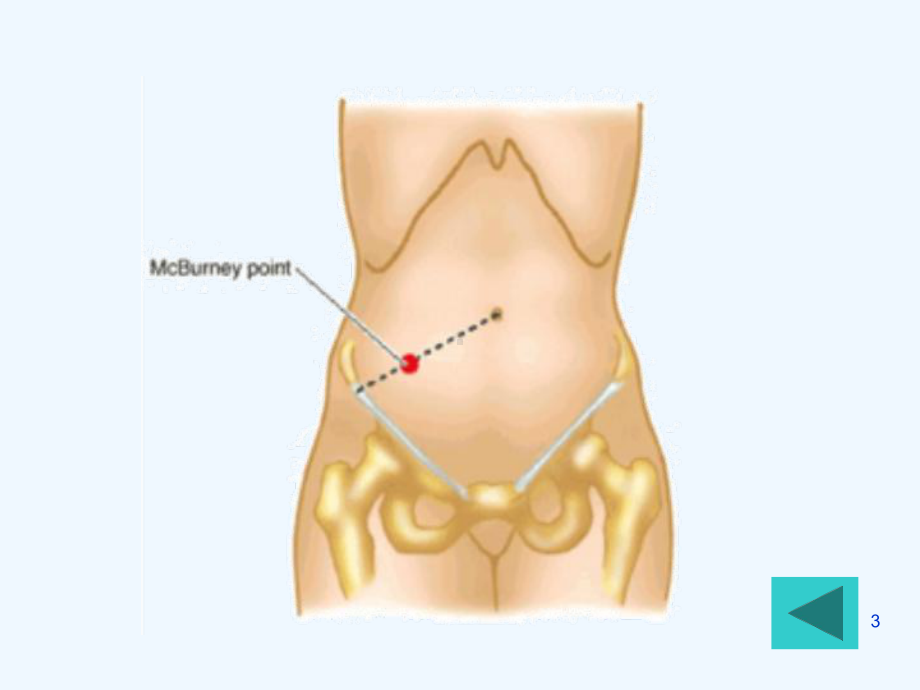 产褥期阑尾炎病人护理课件.ppt_第3页
