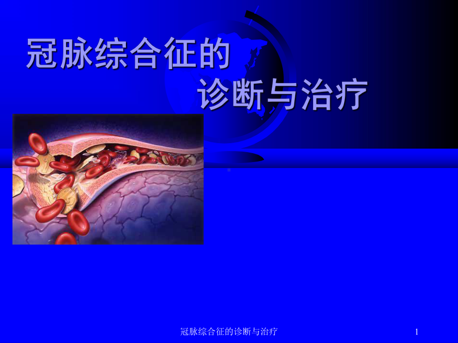 冠脉综合征的诊断与治疗课件.ppt_第1页