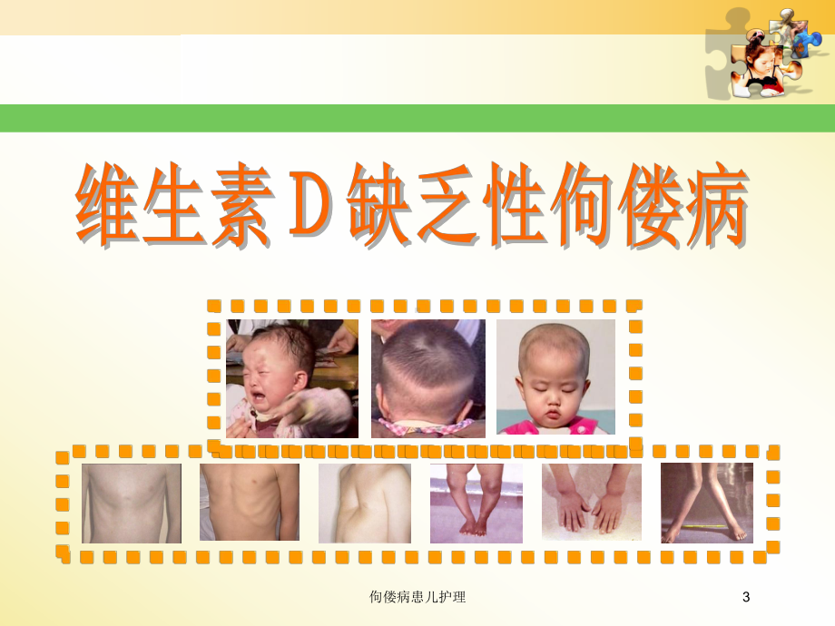 佝偻病患儿护理培训课件.ppt_第3页