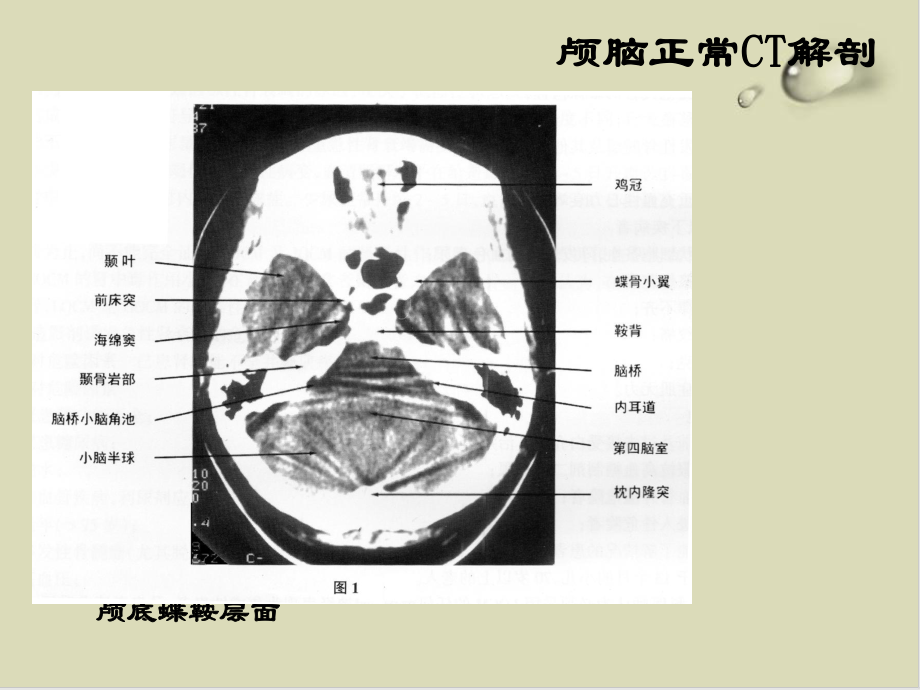 头部CT解剖及诊断基础培训课件.ppt_第3页