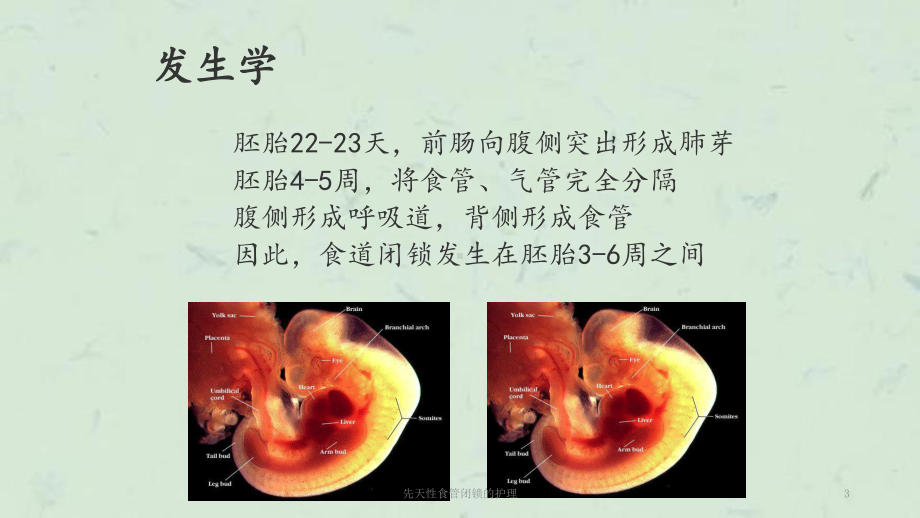 先天性食管闭锁的护理课件.ppt_第3页