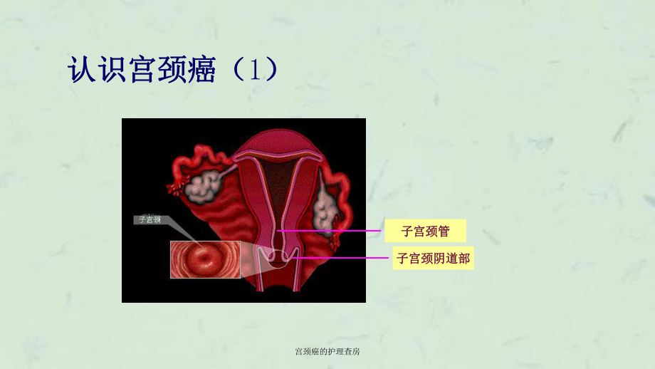 宫颈癌的护理查房课件.ppt_第2页