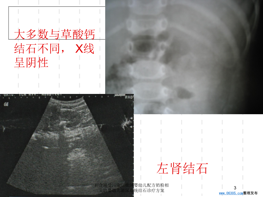 和食用受污染三鹿牌婴幼儿配方奶粉相关的婴幼儿泌尿系统结石诊疗方案培训课件.ppt_第3页