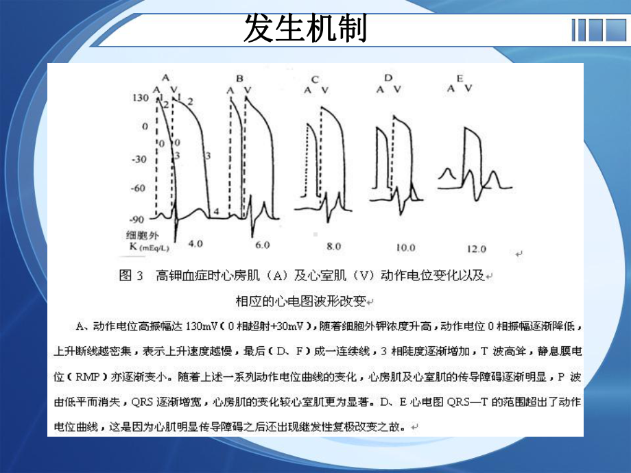 医学课件电解质紊乱心电图.ppt_第3页