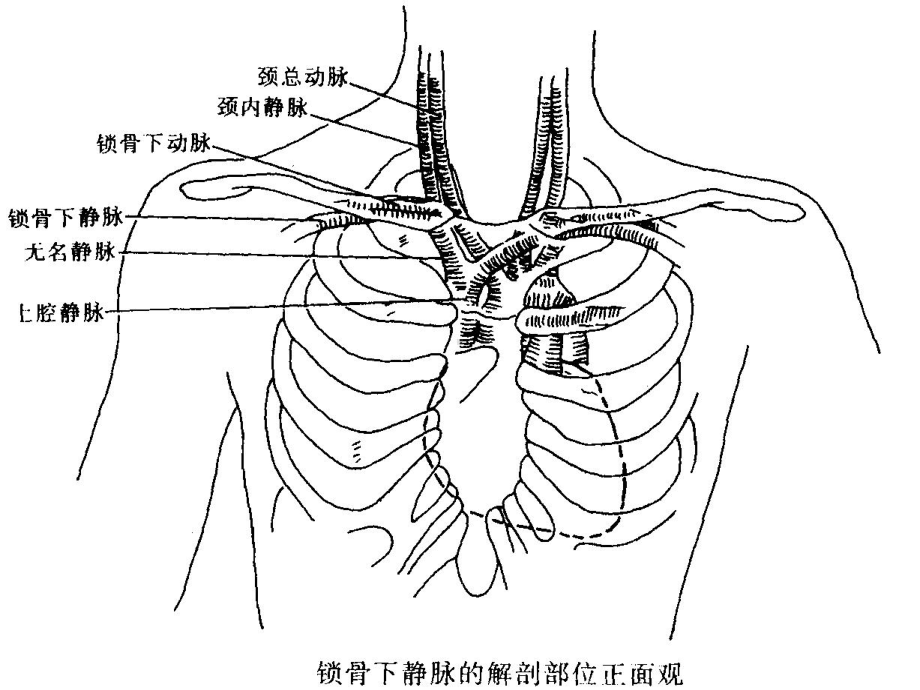 医学锁骨下静脉穿刺置管术专题培训课件.ppt_第3页