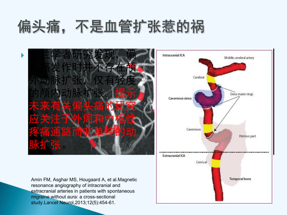 偏头痛与中枢敏化课件.ppt_第2页