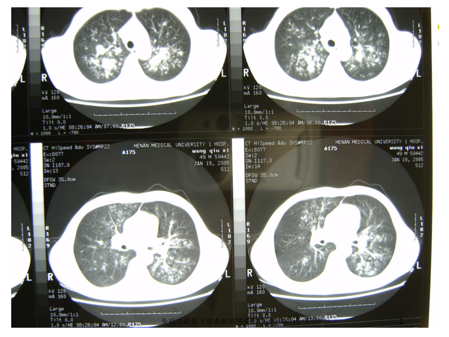 免疫功能低下患者肺部感染的诊治策略培训课件.ppt_第2页