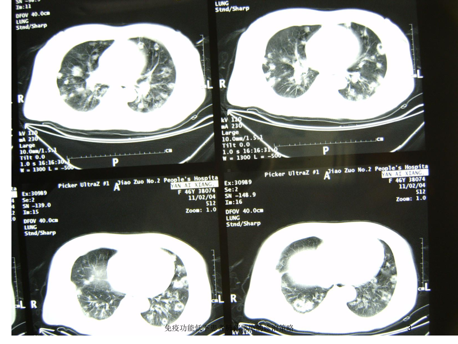 免疫功能低下患者肺部感染的诊治策略培训课件.ppt_第3页
