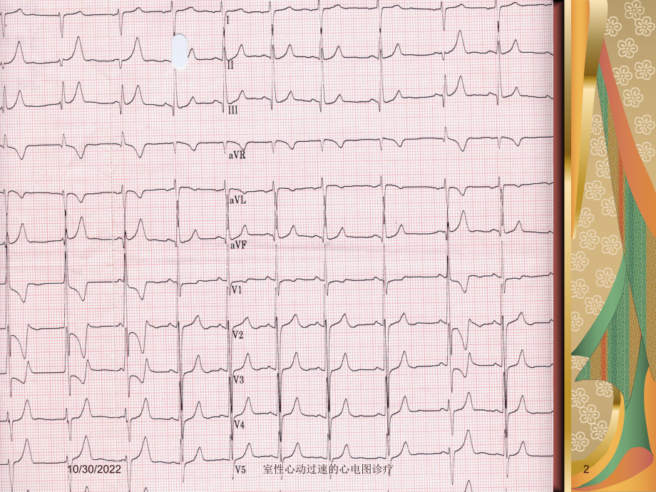 室性心动过速的心电图诊疗课件.ppt_第2页