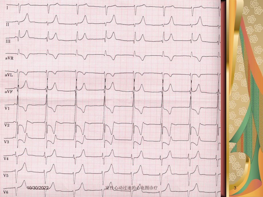 室性心动过速的心电图诊疗课件.ppt_第3页
