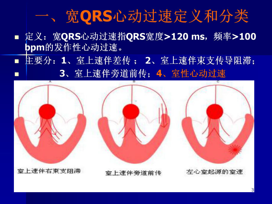 宽QRS心动过速心电图鉴别诊断参考课件.ppt_第3页