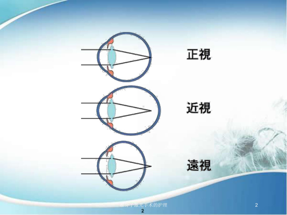 准分子激光手术的护理培训课件.ppt_第2页