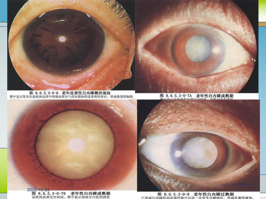 小切口白内障手术培训课件.ppt_第2页