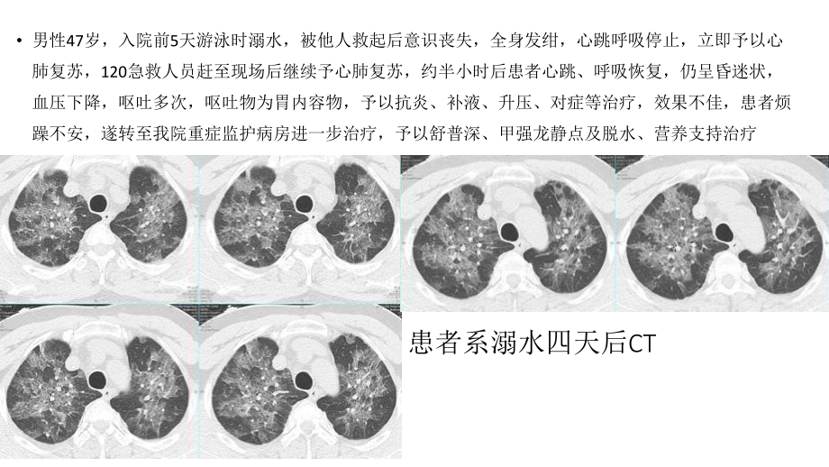 医学课件溺水肺专业知识.ppt_第1页