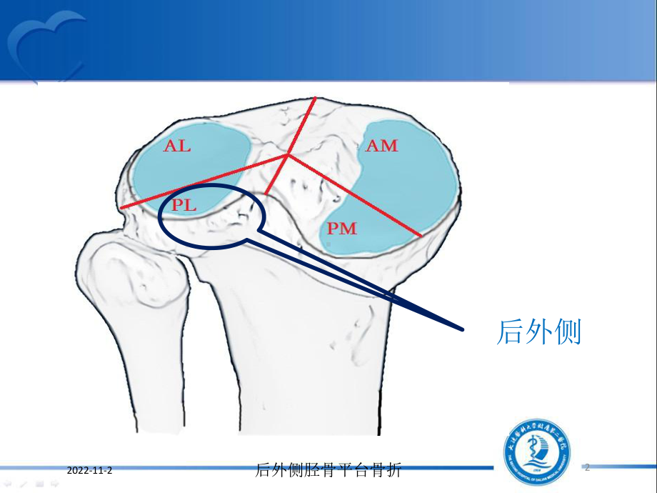 后外侧胫骨平台骨折课件.ppt_第2页