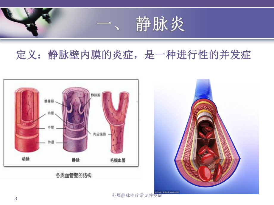 外周静脉治疗常见并发症培训课件.ppt_第3页