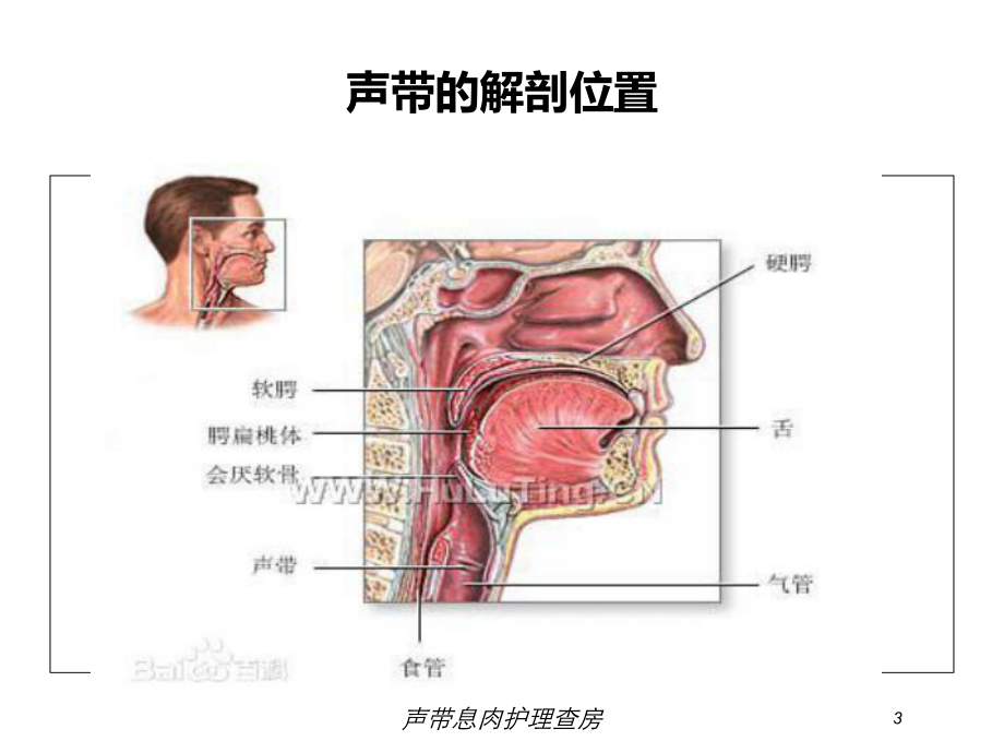 声带息肉护理查房培训课件.ppt_第3页