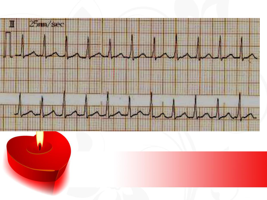 医学课件阵发性室上性心动过速的治疗和医疗护理.ppt_第3页