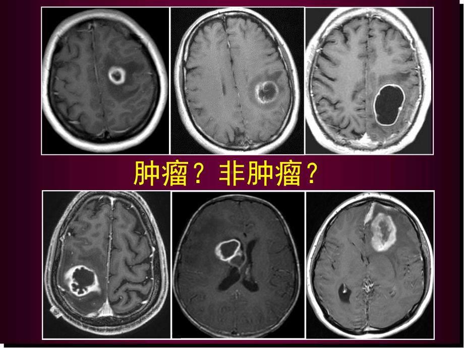 医学课件-脑内常见环形强化病变课件.ppt_第2页