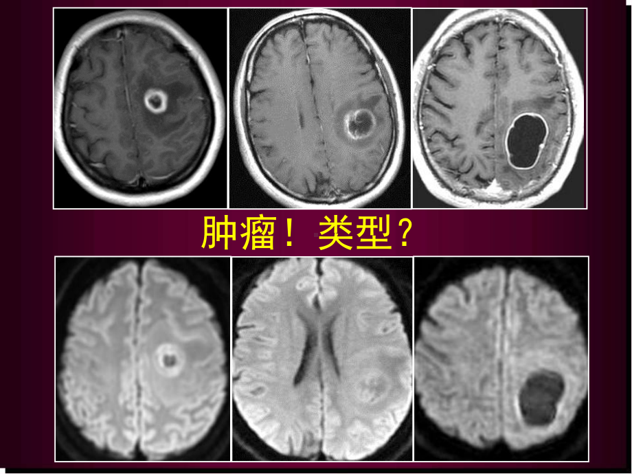 医学课件-脑内常见环形强化病变课件.ppt_第3页